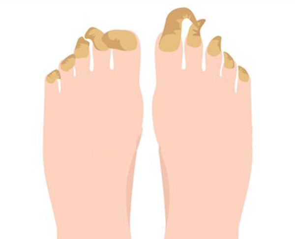 ονυχογρύπωση-ποδολογικό-αγρίνιο